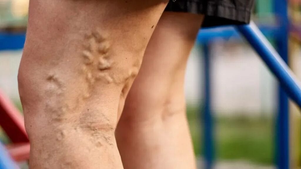 What are varicose veins