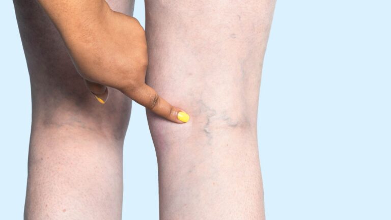Who Treats Venous Insufficiency