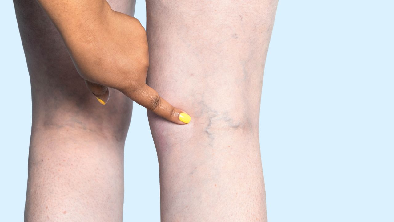 Who Treats Venous Insufficiency