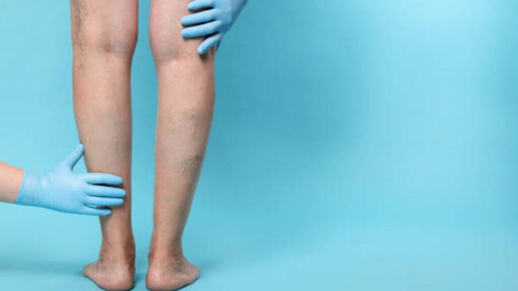 is chronic venous insufficiency