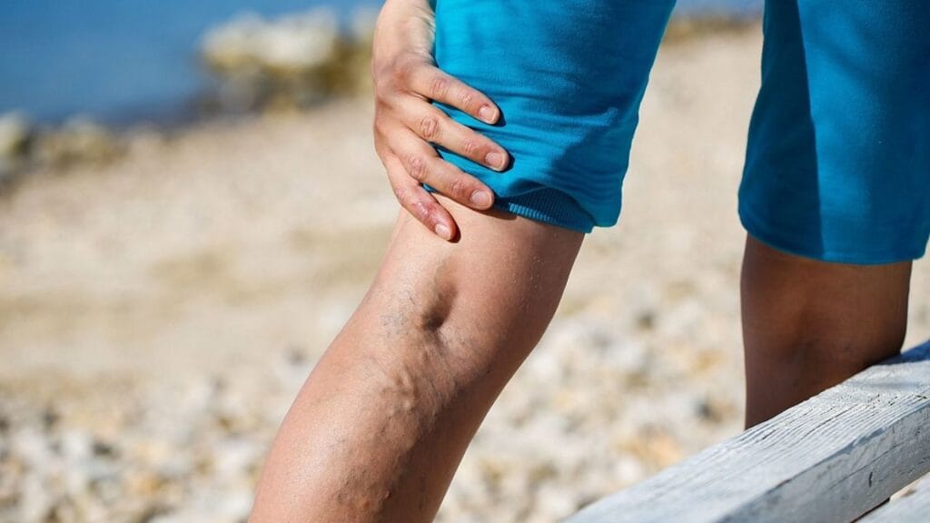 Are Varicose Veins Hereditary