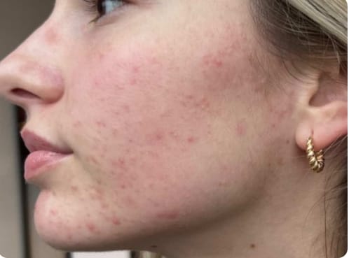 Screenshot_3-4-2026_01040_skinpen.com