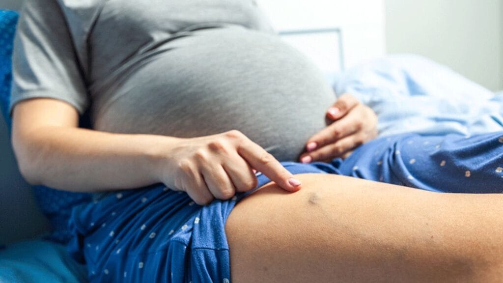 Varicose Veins During Pregnancy