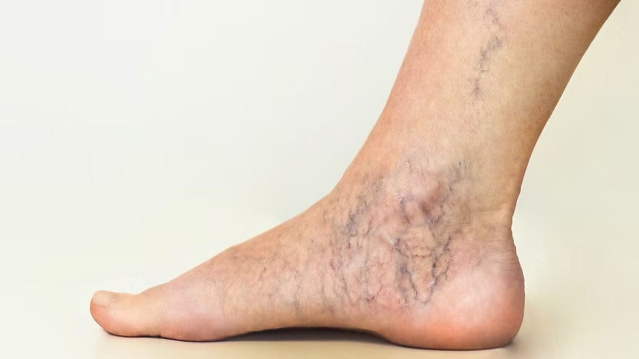 What Causes Varicose Veins
