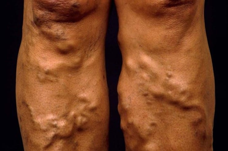 What Do Varicose Veins Look Like