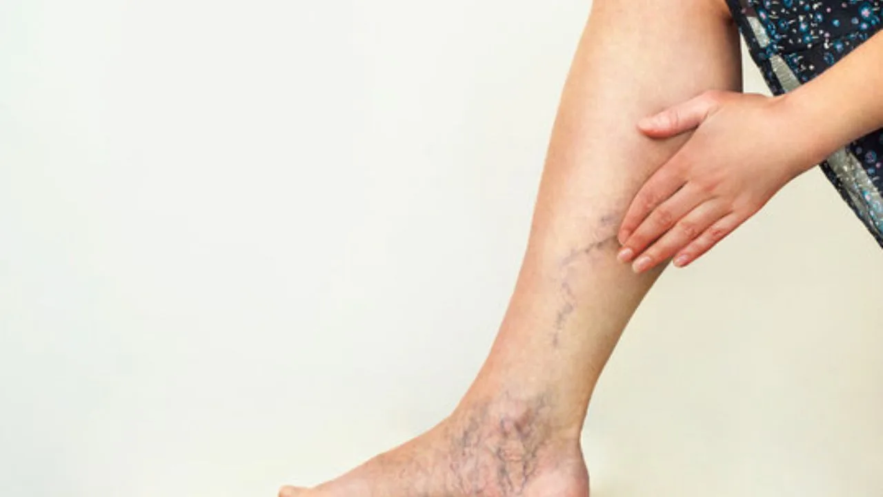 How to Get Rid of Varicose Veins Naturally