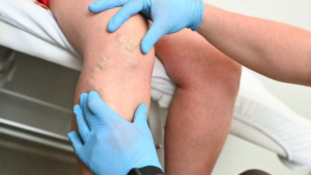 RFA vs Laser for Varicose Veins (EVLT)