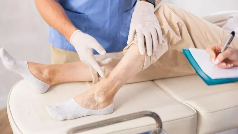 VenaSeal for Varicose Veins